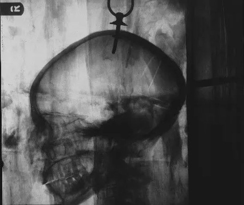 X-rays showing the staple in Irtyru’s body and the bolt and ring attachment in her skull.