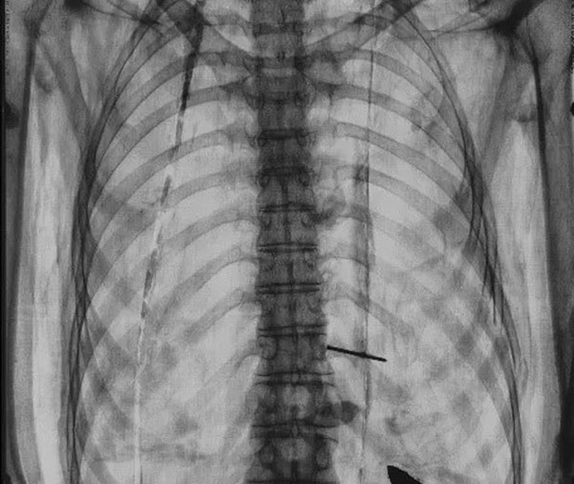 X-rays showing the staple in Irtyru’s body and the bolt and ring attachment in her skull.
