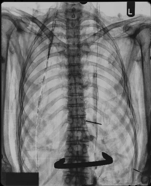 X-rays showing the staple in Irtyru’s body and the bolt and ring attachment in her skull.