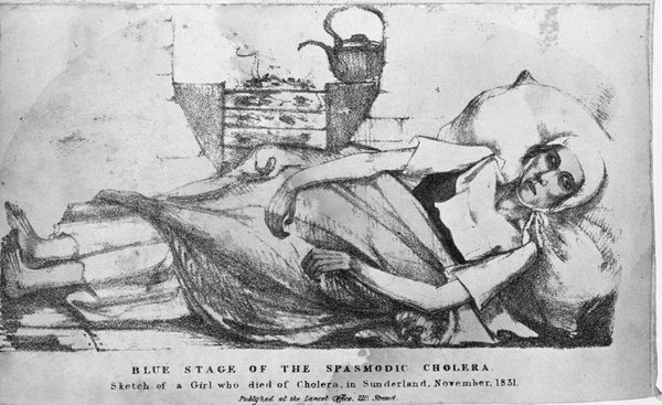 Lithograph of young girl suffering from cholera (an acute diarrhoeal disease).