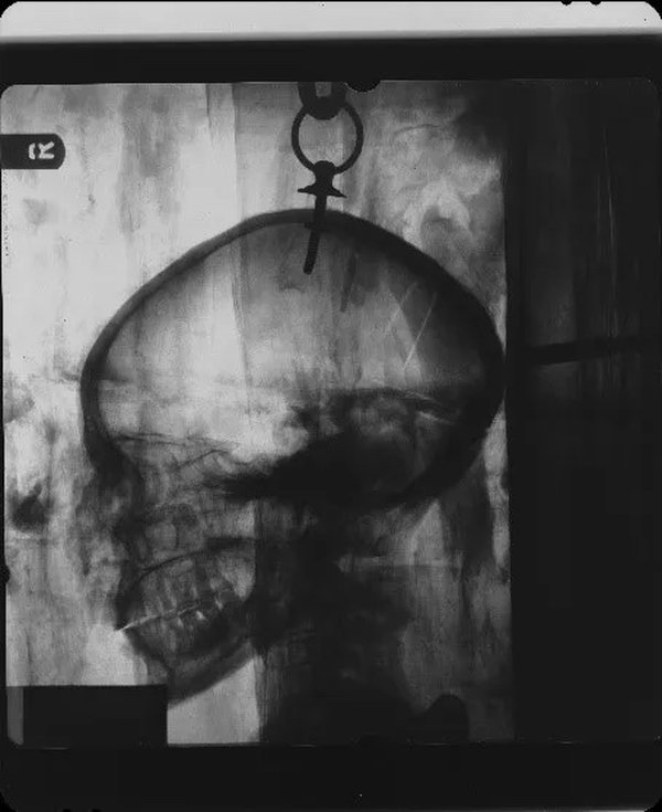 X-rays showing the staple in Irtyru’s body and the bolt and ring attachment in her skull.